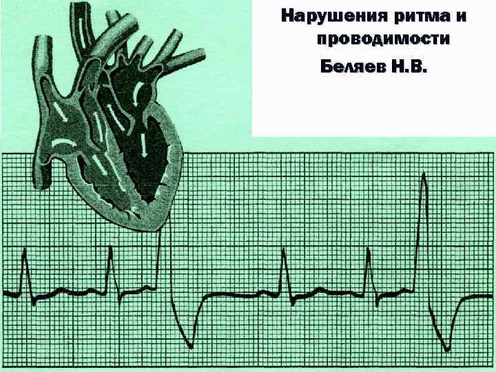 Нарушения ритма и проводимости Беляев Н. В. 