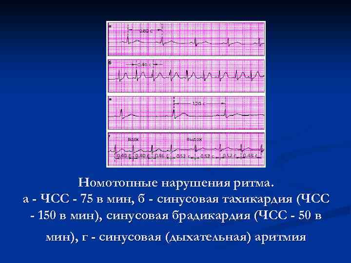 Номотопные нарушения ритма. а - ЧСС - 75 в мин, б - синусовая тахикардия