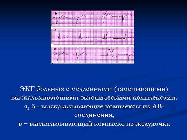 ЭКГ больных с медленными (замещающими) выскальзывающими эктопическими комплексами. а, б - выскальзывающие комплексы из