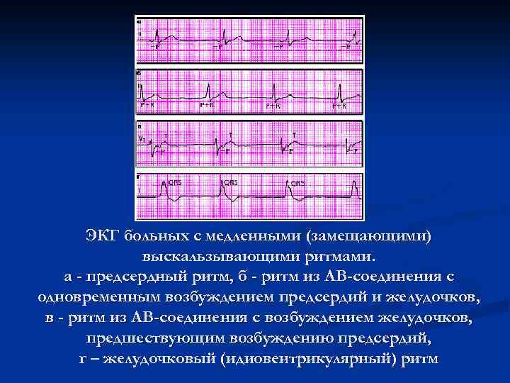 ЭКГ больных с медленными (замещающими) выскальзывающими ритмами. а - предсердный ритм, б - ритм