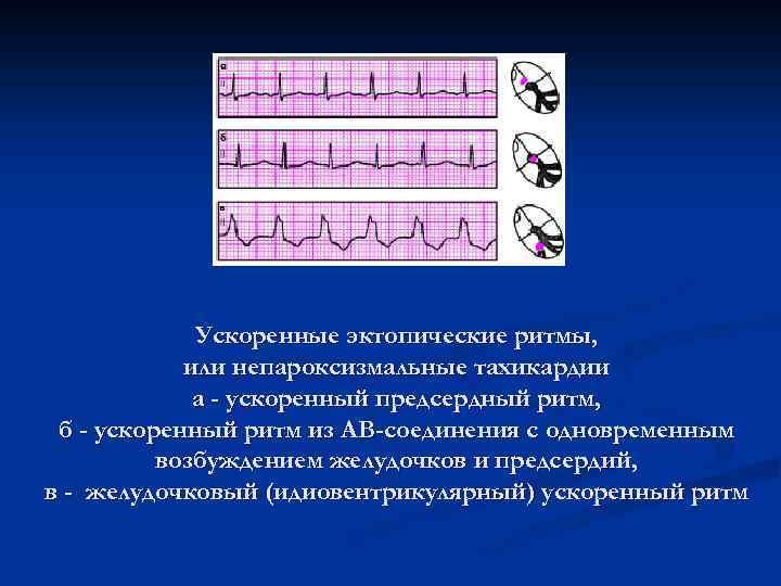 Ускоренные эктопические ритмы, или непароксизмальные тахикардии а - ускоренный предсердный ритм, б - ускоренный