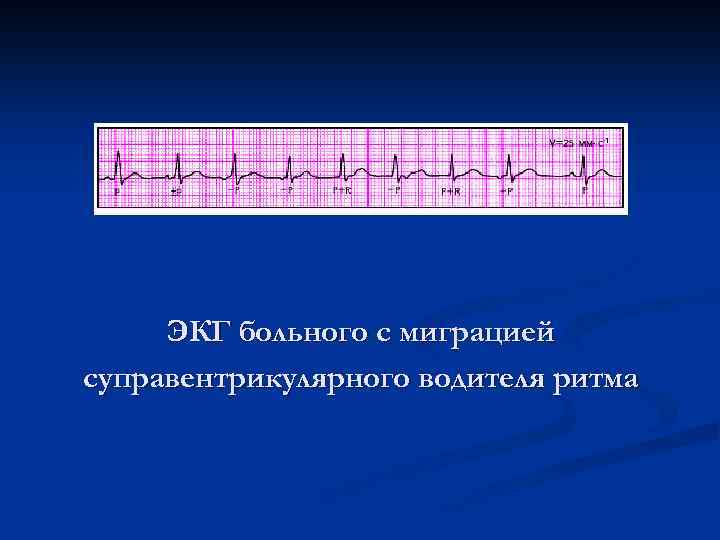 ЭКГ больного с миграцией суправентрикулярного водителя ритма 