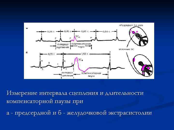 Измерение интервала сцепления и длительности компенсаторной паузы при а - предсердной и б -