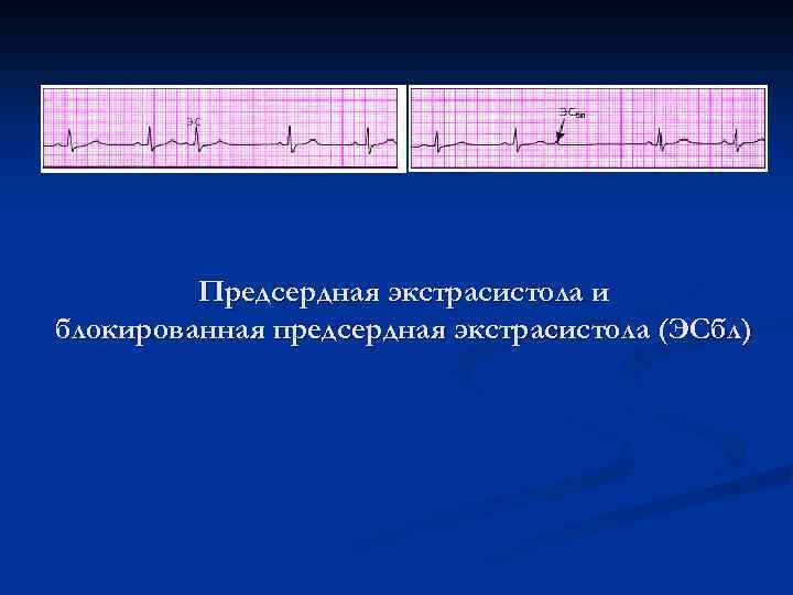 Предсердная экстрасистола и блокированная предсердная экстрасистола (ЭСбл) 