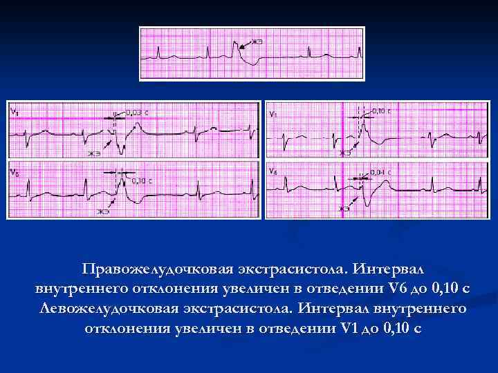 Правожелудочковая экстрасистола. Интервал внутреннего отклонения увеличен в отведении V 6 до 0, 10 с