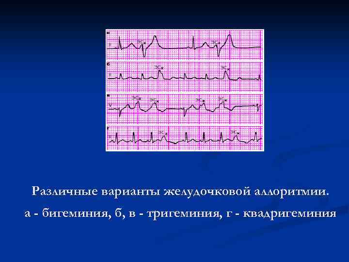 Различные варианты желудочковой аллоритмии. а - бигеминия, б, в - тригеминия, г - квадригеминия