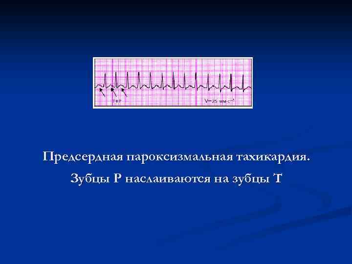 Предсердная пароксизмальная тахикардия. Зубцы Р наслаиваются на зубцы Т 