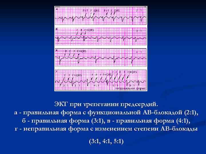 ЭКГ при трепетании предсердий. а - правильная форма с функциональной АВ-блокадой (2: 1), б