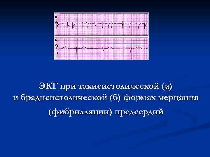 ЭКГ при тахисистолической (а) и брадисистолической (б) формах мерцания (фибрилляции) предсердий 