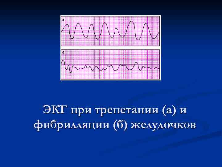 ЭКГ при трепетании (а) и фибрилляции (б) желудочков 