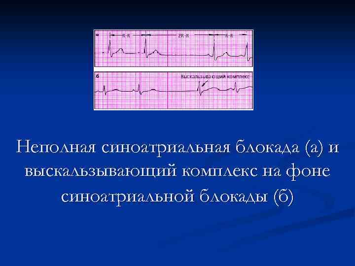 Неполная синоатриальная блокада (а) и выскальзывающий комплекс на фоне синоатриальной блокады (б) 