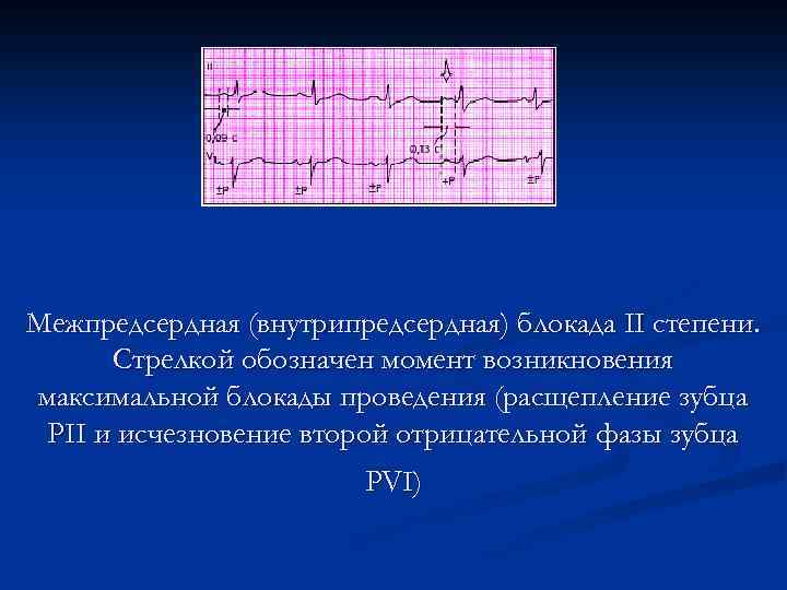 Межпредсердная (внутрипредсердная) блокада II степени. Стрелкой обозначен момент возникновения максимальной блокады проведения (расщепление зубца