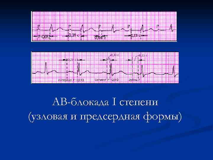 АВ-блокада I степени (узловая и предсердная формы) 