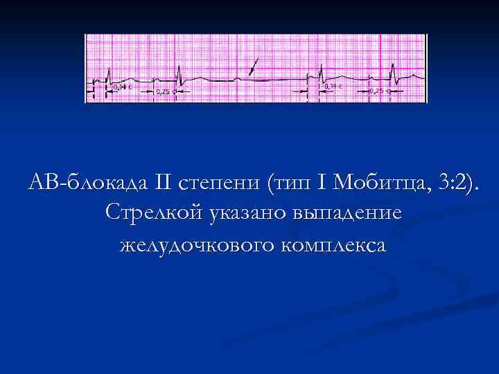 АВ-блокада II степени (тип I Мобитца, 3: 2). Стрелкой указано выпадение желудочкового комплекса 