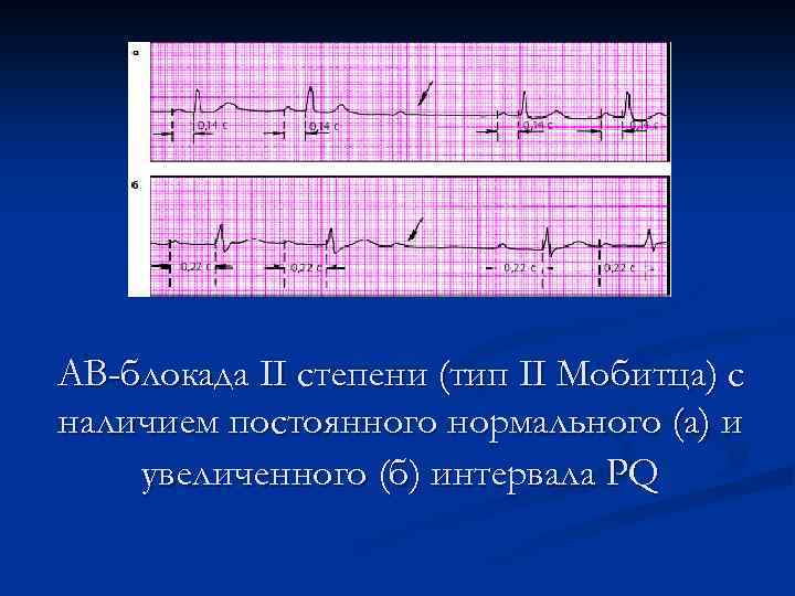 АВ-блокада II степени (тип II Мобитца) с наличием постоянного нормального (а) и увеличенного (б)