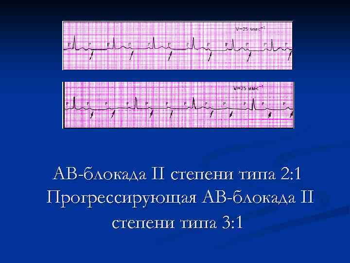 АВ-блокада II степени типа 2: 1 Прогрессирующая АВ-блокада II степени типа 3: 1 