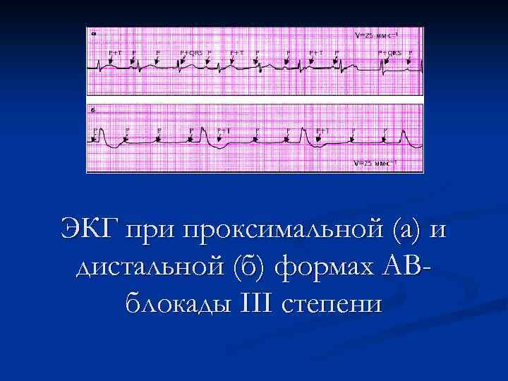 ЭКГ при проксимальной (а) и дистальной (б) формах АВблокады III степени 