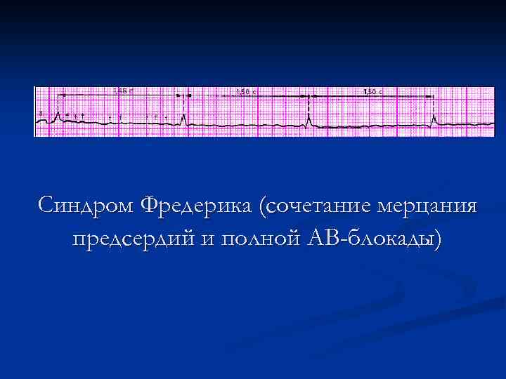 Синдром Фредерика (сочетание мерцания предсердий и полной АВ-блокады) 