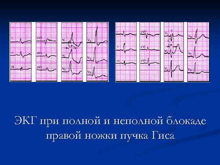 ЭКГ при полной и неполной блокаде правой ножки пучка Гиса 