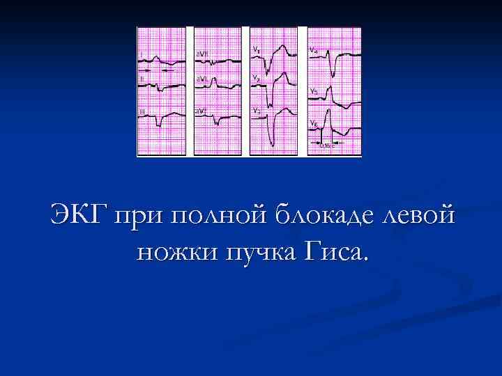 ЭКГ при полной блокаде левой ножки пучка Гиса. 