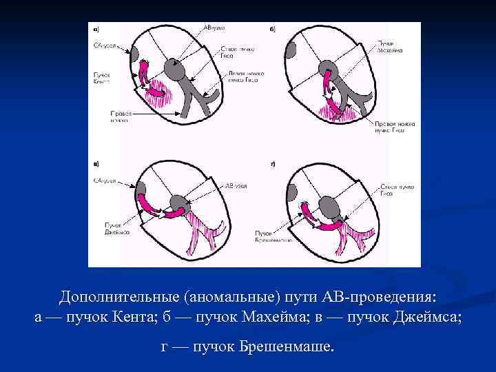 Дополнительные (аномальные) пути АВ-проведения: а — пучок Кента; б — пучок Махейма; в —