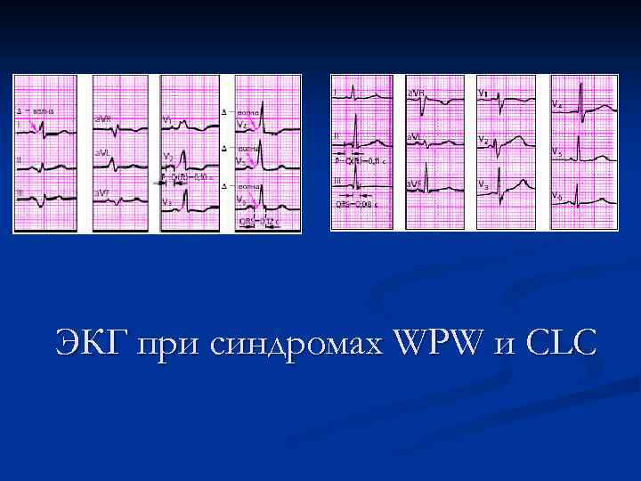 ЭКГ при синдромах WPW и CLC 