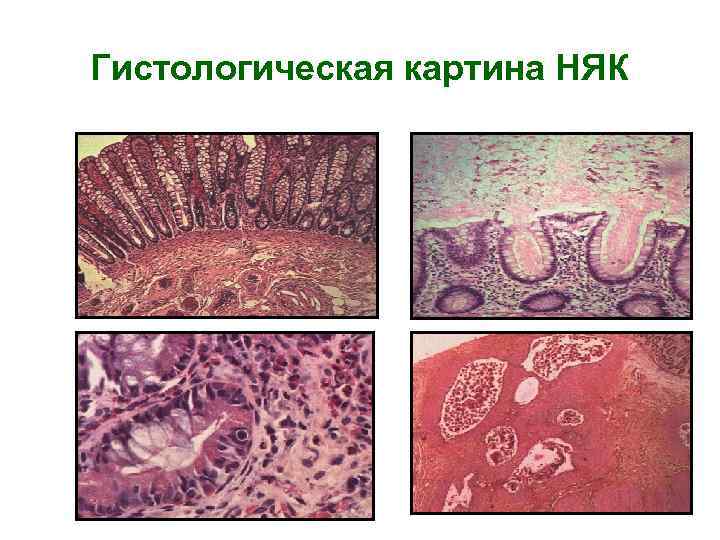 Гистологическая картина НЯК норма 