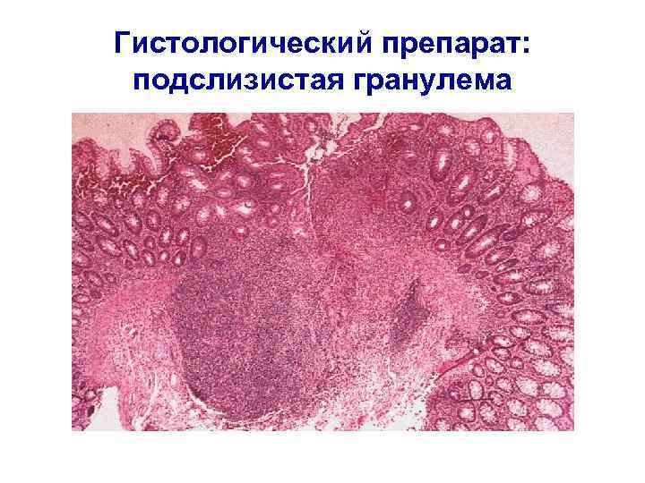 Гистологический препарат: подслизистая гранулема 