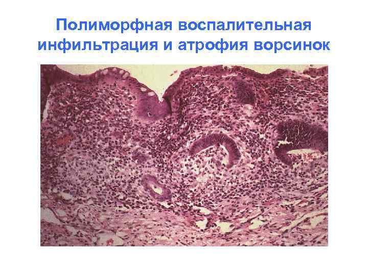 Полиморфная воспалительная инфильтрация и атрофия ворсинок 