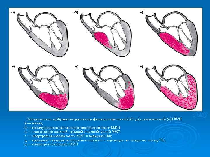  Схематическое изображение различных форм асимметричной (б–д) и симметричной (е) ГКМП: а — норма;
