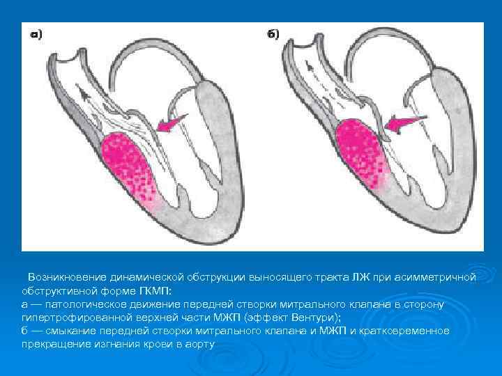  Возникновение динамической обструкции выносящего тракта ЛЖ при асимметричной обструктивной форме ГКМП: а —