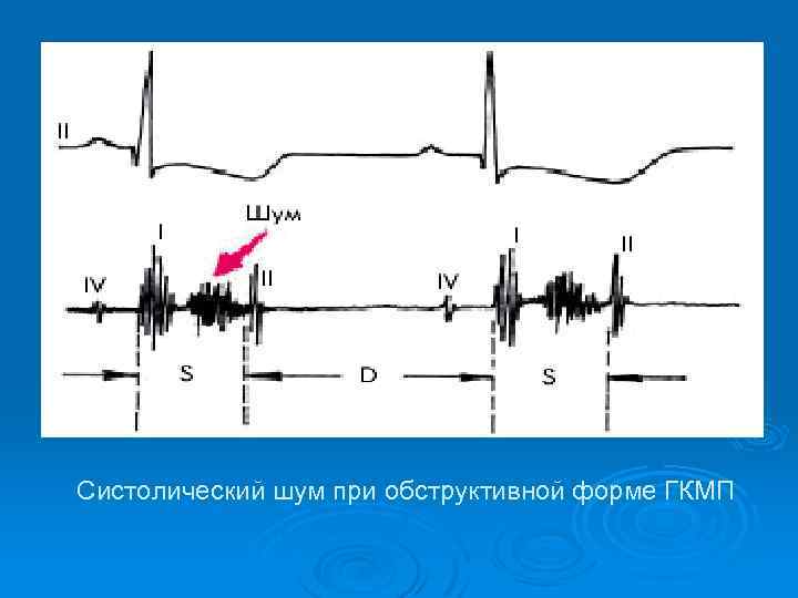  Систолический шум при обструктивной форме ГКМП 