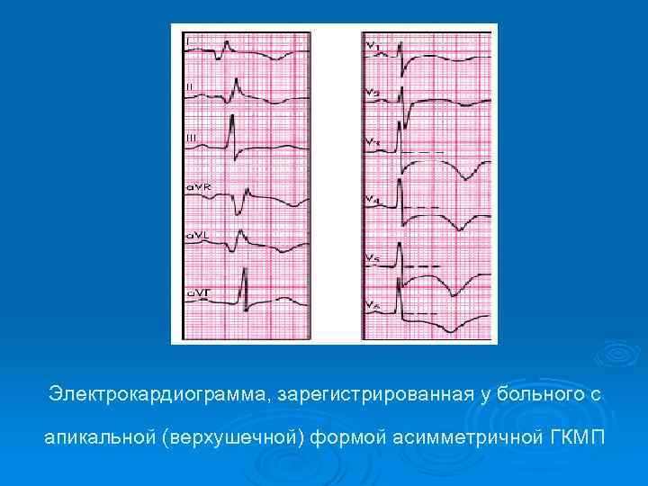 Электрокардиограмма, зарегистрированная у больного с апикальной (верхушечной) формой асимметричной ГКМП 