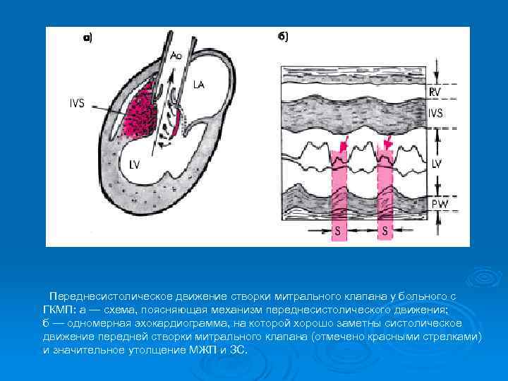  Переднесистолическое движение створки митрального клапана у больного с ГКМП: а — схема, поясняющая