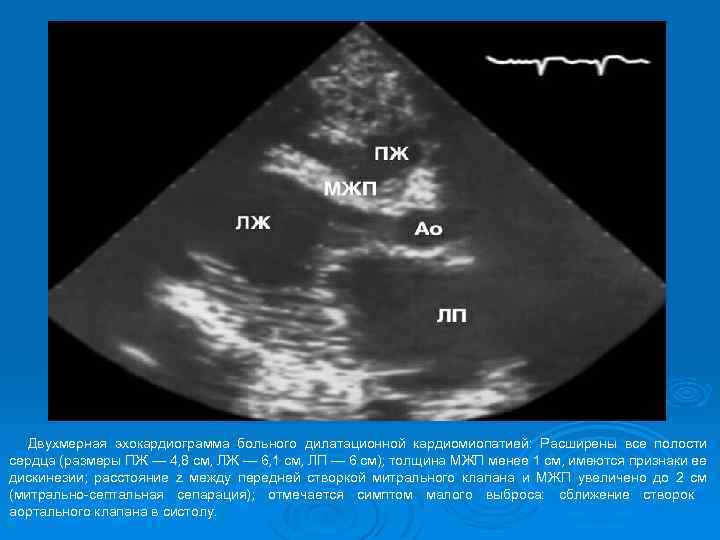 Двухмерная эхокардиограмма больного дилатационной кардиомиопатией: Расширены все полости сердца (размеры ПЖ — 4, 8