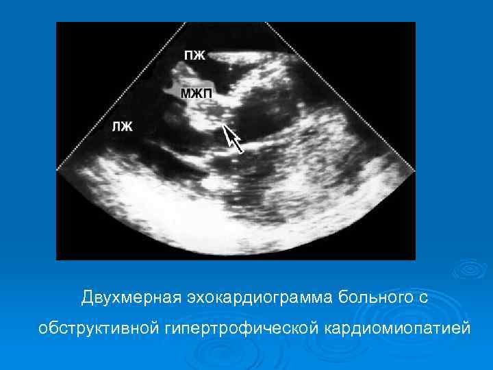 Двухмерная эхокардиограмма больного с обструктивной гипертрофической кардиомиопатией 