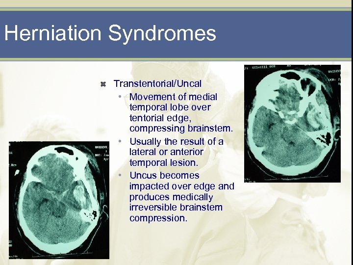 Herniation Syndromes Transtentorial/Uncal • Movement of medial temporal lobe over tentorial edge, compressing brainstem.