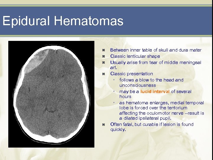 Epidural Hematomas Between inner table of skull and dura mater Classic lenticular shape Usually