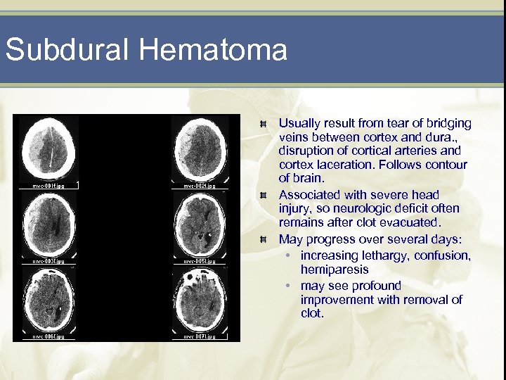 Subdural Hematoma Usually result from tear of bridging veins between cortex and dura. ,