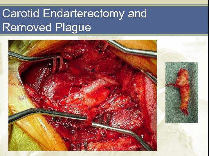 Carotid Endarterectomy and Removed Plague 