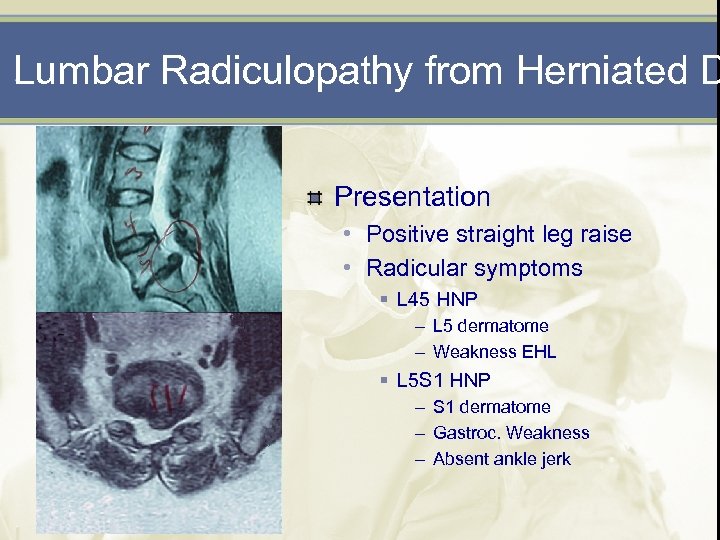 Lumbar Radiculopathy from Herniated D Presentation • Positive straight leg raise • Radicular symptoms