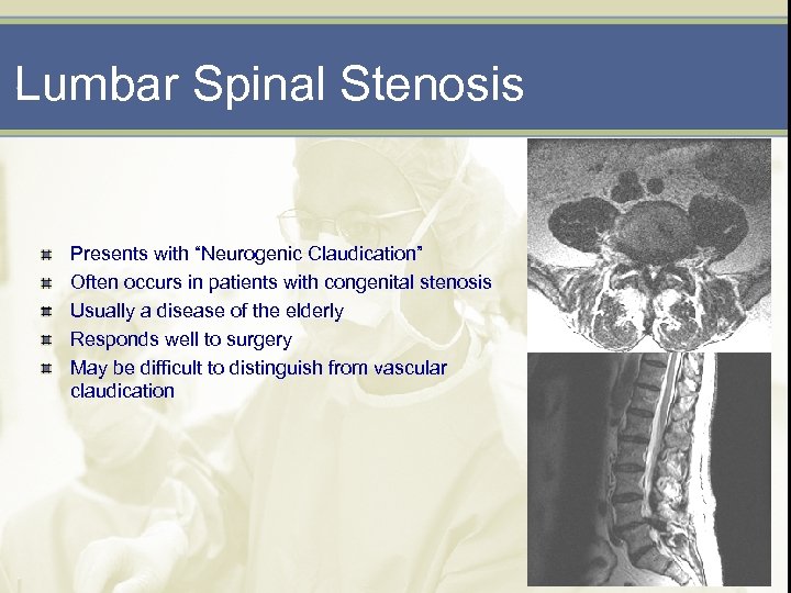 Lumbar Spinal Stenosis Presents with “Neurogenic Claudication” Often occurs in patients with congenital stenosis