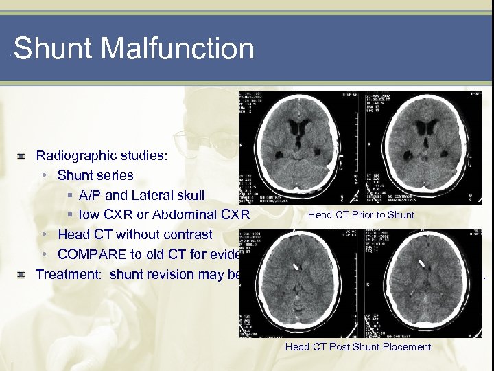 Shunt Malfunction Radiographic studies: • Shunt series § A/P and Lateral skull Head CT