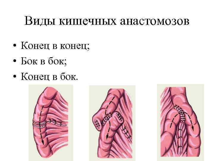 Анастомоз конец в конец схема