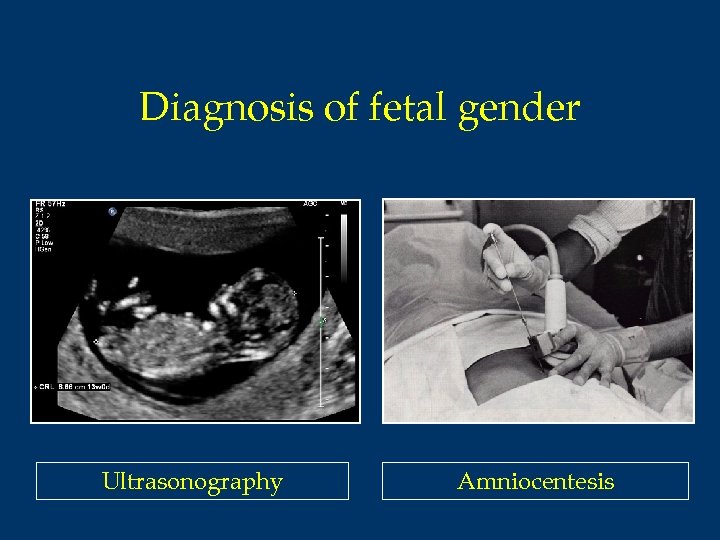Diagnosis of fetal gender Ultrasonography Amniocentesis 