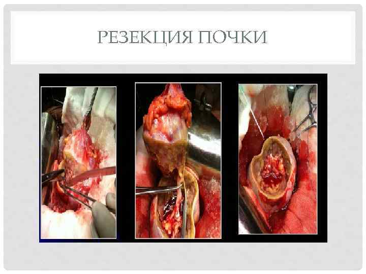 РЕЗЕКЦИЯ ПОЧКИ 