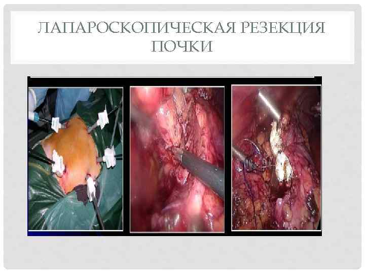 ЛАПАРОСКОПИЧЕСКАЯ РЕЗЕКЦИЯ ПОЧКИ 