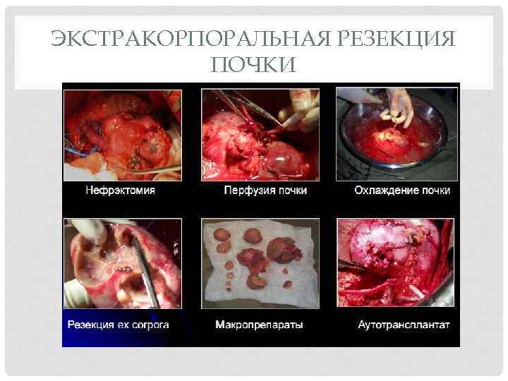ЭКСТРАКОРПОРАЛЬНАЯ РЕЗЕКЦИЯ ПОЧКИ 