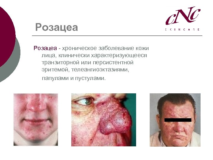Розацеа - хроническое заболевание кожи лица, клинически характеризующееся транзиторной или персистентной эритемой, телеангиоэктазиями, папулами