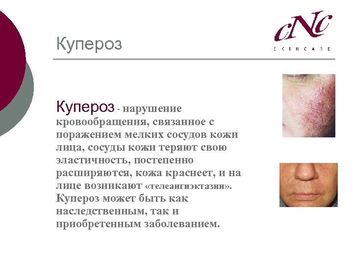Купероз - нарушение кровообращения, связанное с поражением мелких сосудов кожи лица, сосуды кожи теряют